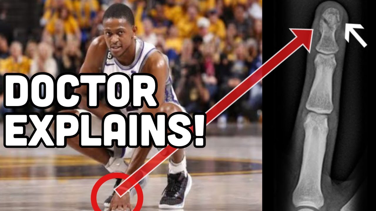 De'Aaron Fox' INSIDIOUS Finger Fracture | How Long is he OUT? | DOCTOR Explains