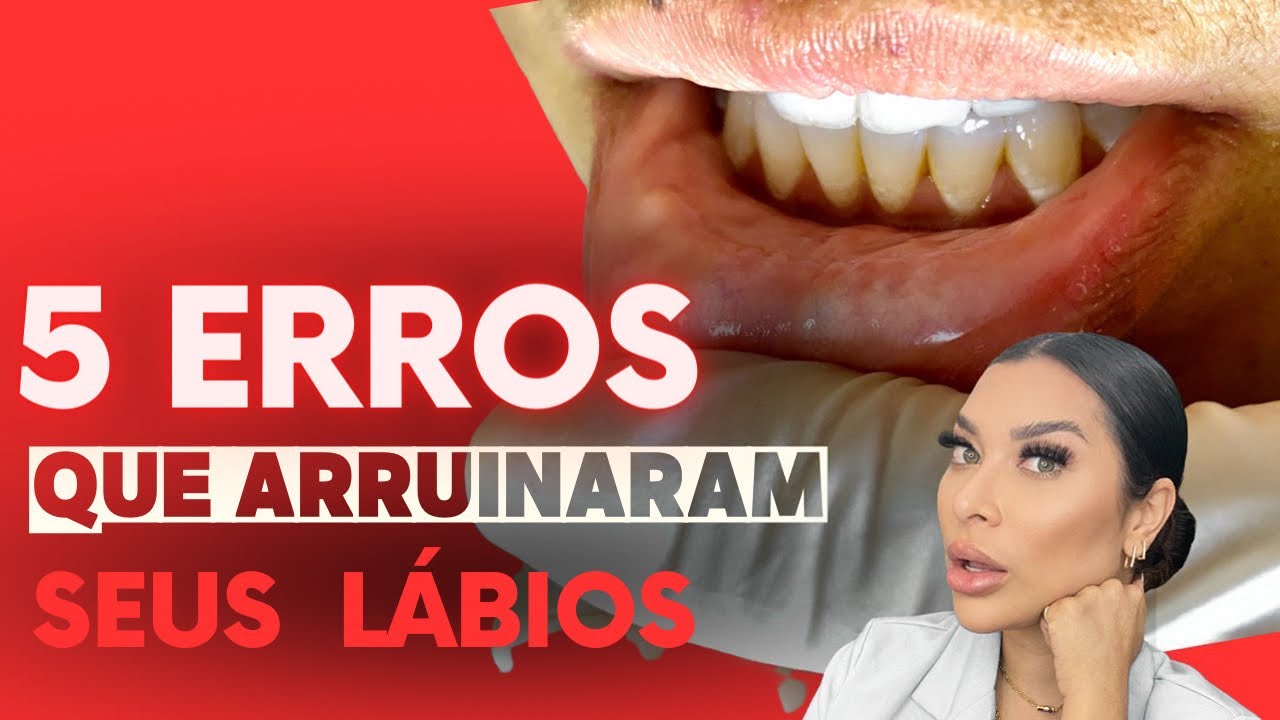 Os 5 Erros mais comuns no Preenchimento Labial