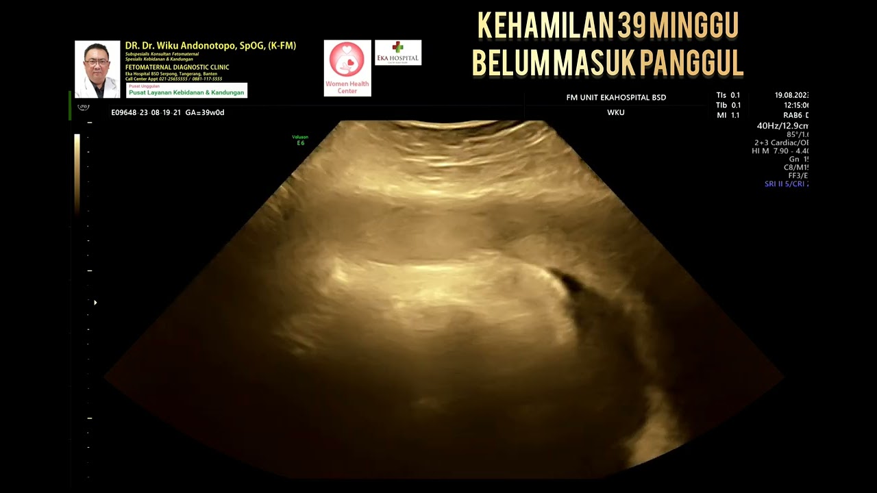 Belum masuk panggul 39 minggu