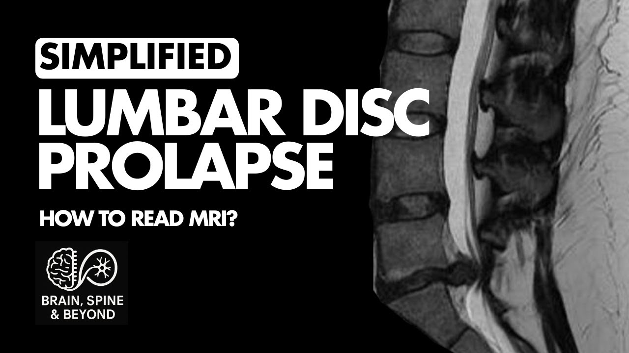 How to Simply Identify Lumbar Disc Prolapse on MRI Scan?