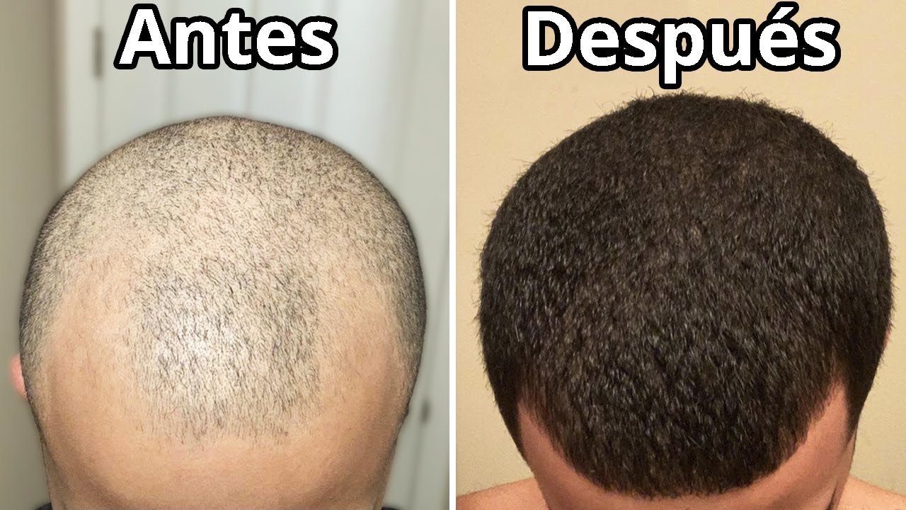 Cómo Recuperar Tu Pelo Sin Trasplante Capilar