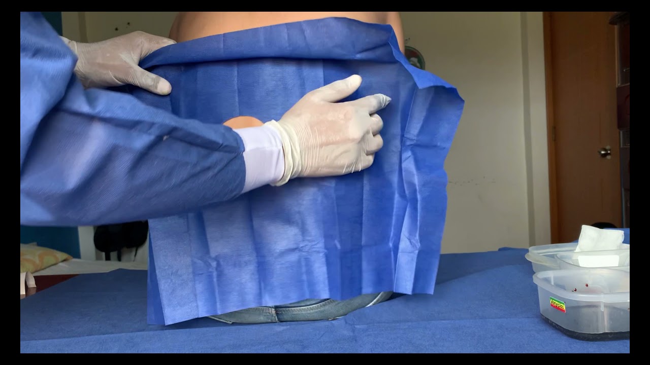 T&Eacute;CNICA DE UNA PUNCI&Oacute;N LUMBAR (EJEMPLO DE ANESTESIA RAQU&Iacute;DEA)