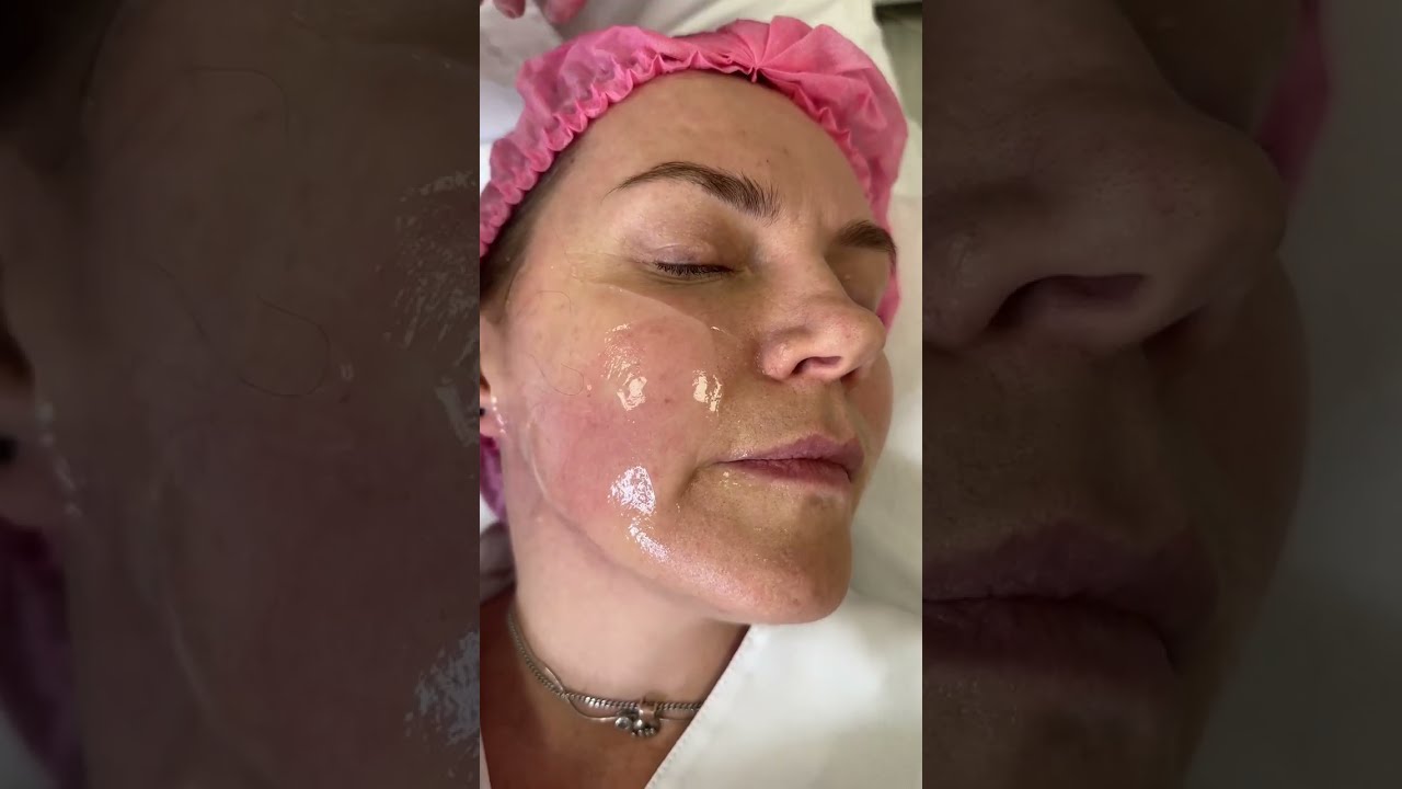 SMAS лифтинг и HELEO4  - омоложение уже сегодня!