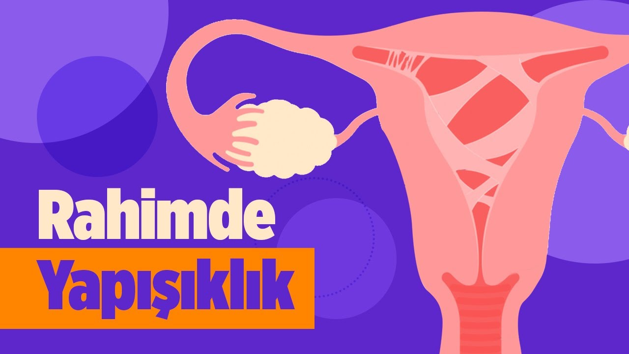 Rahimde Yapışıklık Nedir, Neden Olur? Rahim İçi Yapışıklık Tedavisi ve Tedavi Sonrası Hamilelik