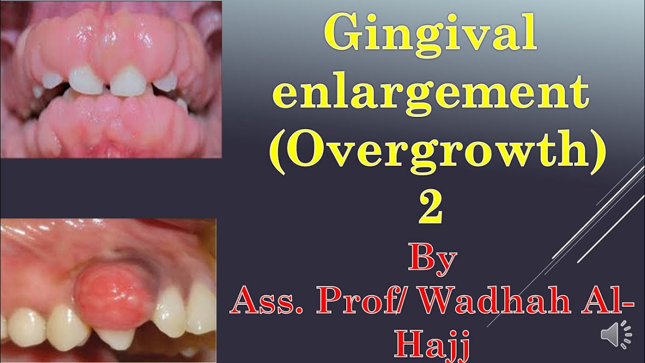 18-Periodontal diseases -7 (Gingival enlargement-2)-Dr Wadhah Periodontology lectures. د/ وضاح الحاج