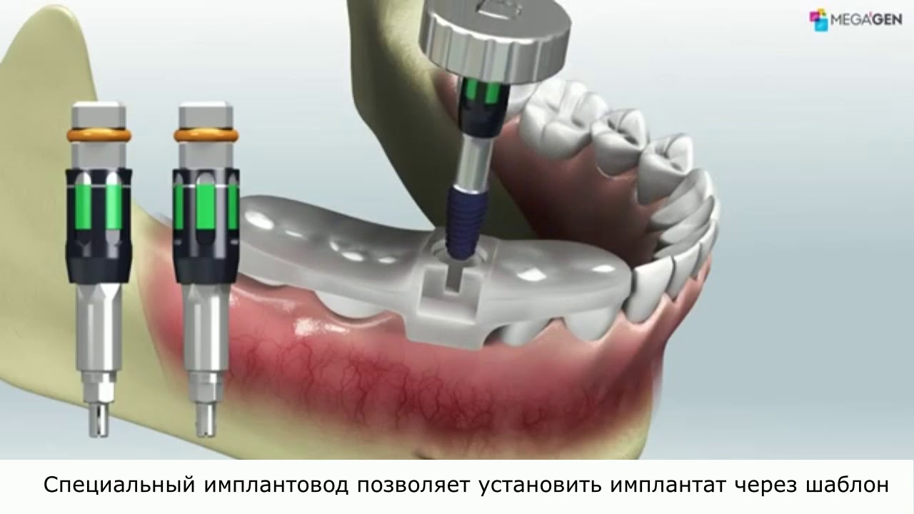 Схема хирургического протокола R2GATE