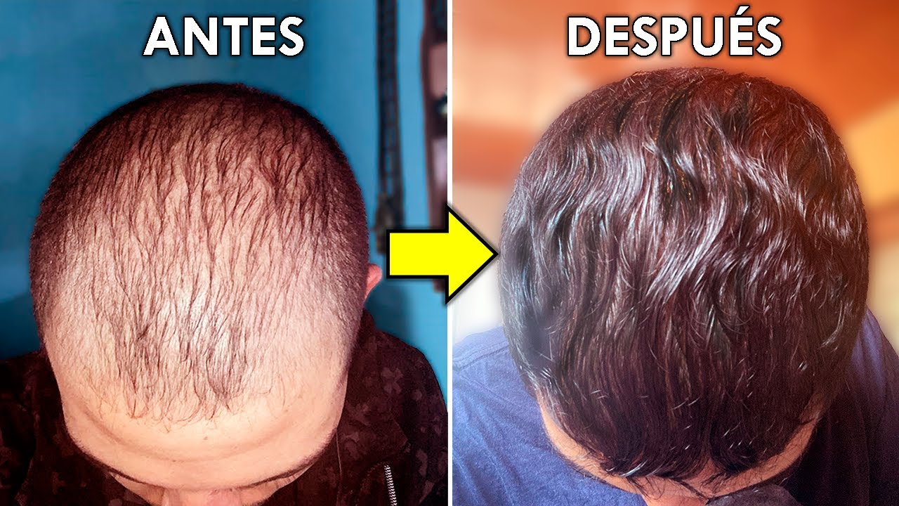 ¿El Secreto Para Recuperar El Pelo En 4 Meses?