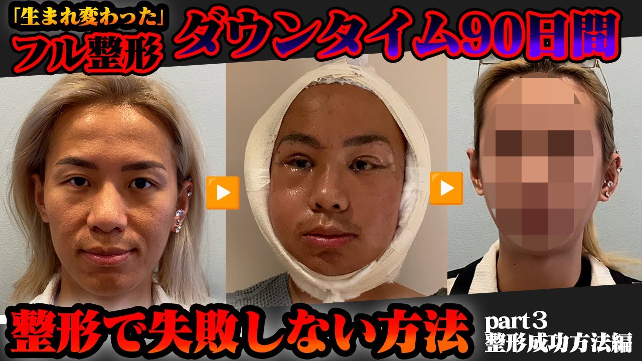【韓国 整形完全保存版】最終編 目 鼻 輪郭 骨削りの全てを見せる 整形を考えてる方は絶対見て Part 3