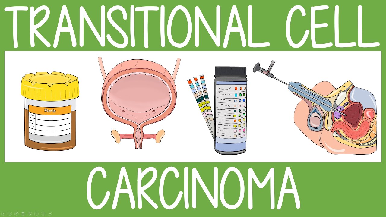 Transitional Cell Carcinoma Visually Explained