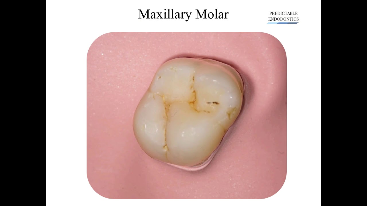 Access cavity preparation