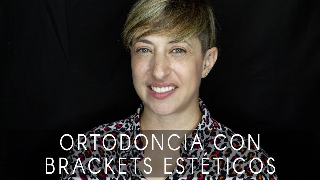 La sonrisa de Isabel: ortodoncia con brackets estéticos