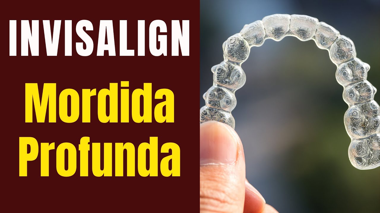 Correção da Mordida Profunda com Invisalign #aparelhortodontico #invisalign #mordidaprofunda