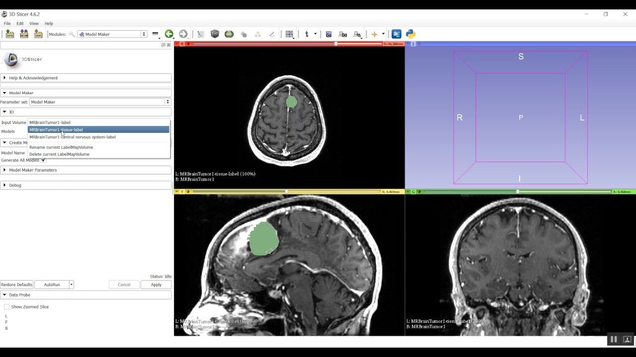 Segmentation & 3D Model Construction using 3D slicer