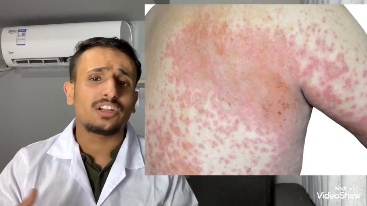 اخيراً 😍 الان في علاج لمرض الأيدز !!! | AIDS