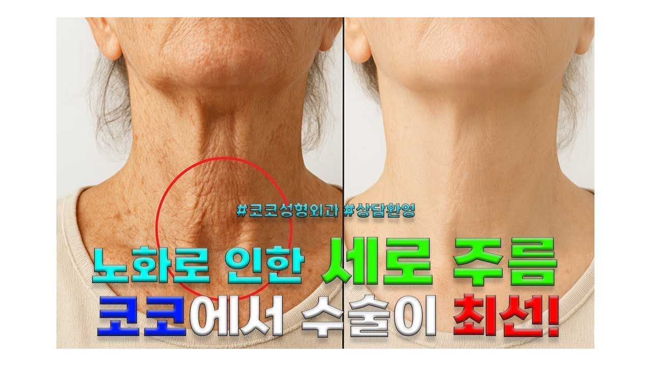[코코성형외과]  노화로 인한 세로주름, 코코에서 수술이 최선! (수정본)