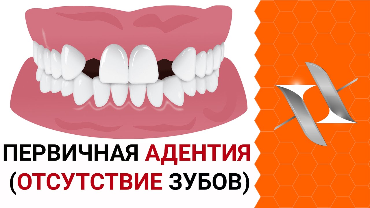 Первичная АДЕНТИЯ (Отсутствие зубов) | Причины. Лечение.