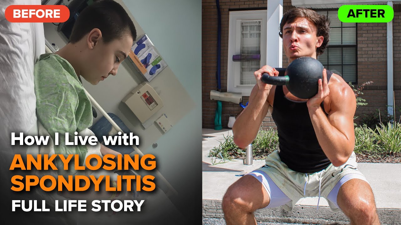 My Story Living with Ankylosing Spondylitis