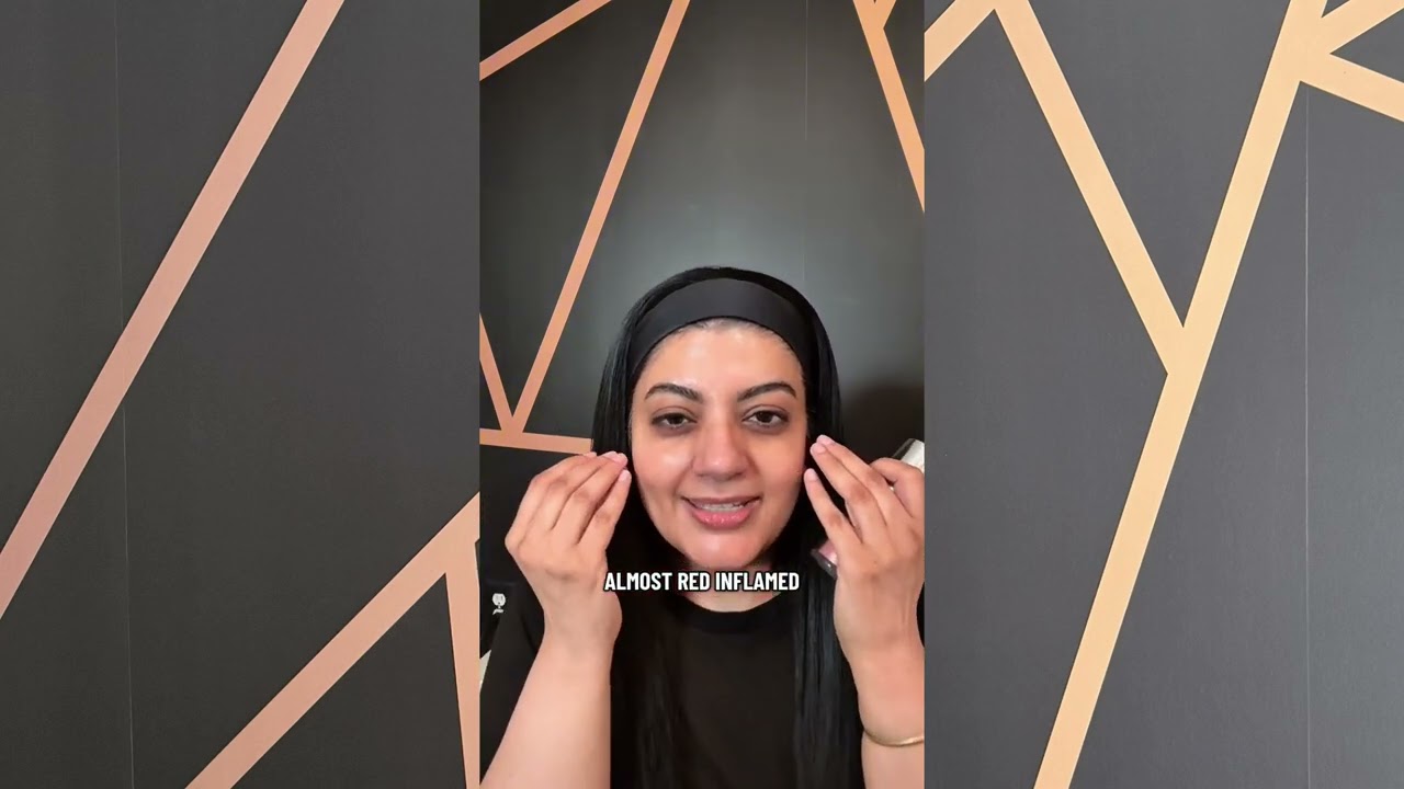 Thiamidol: The Pigmentation Breakthrough I Actually Use