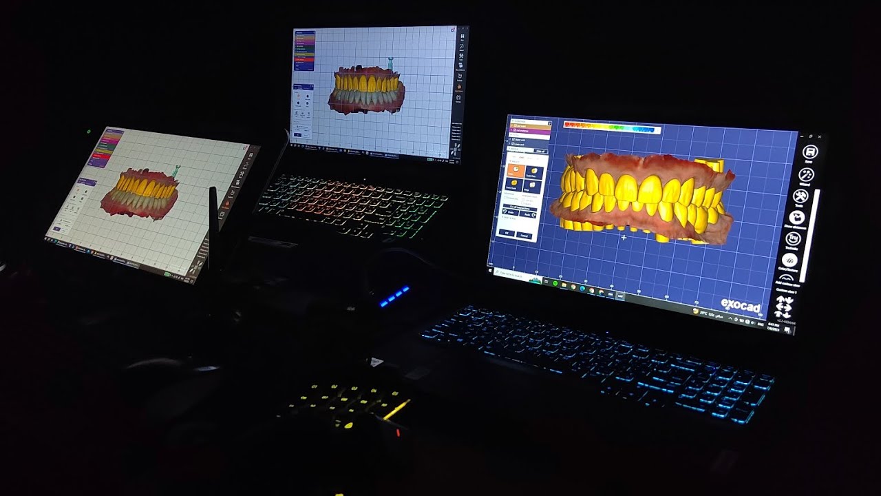 Exocad Huion Pen For One Unit