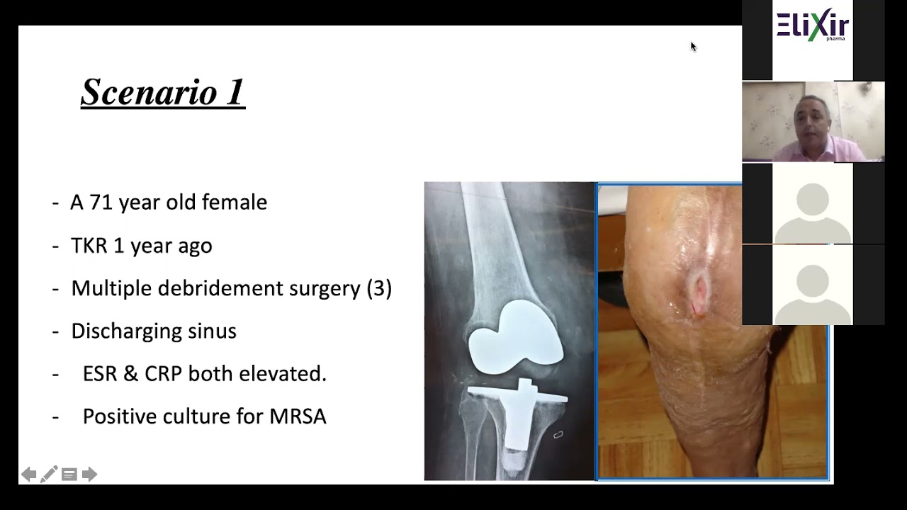 Prof Wael Samir systematice analysis of painfull total knee prosthesis