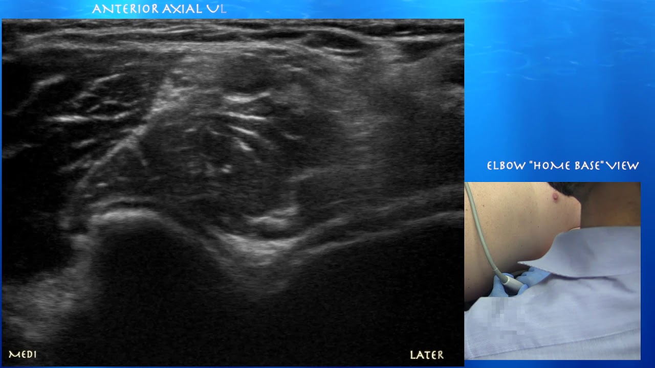 Ultrasound of a normal Distal Biceps tendon ..