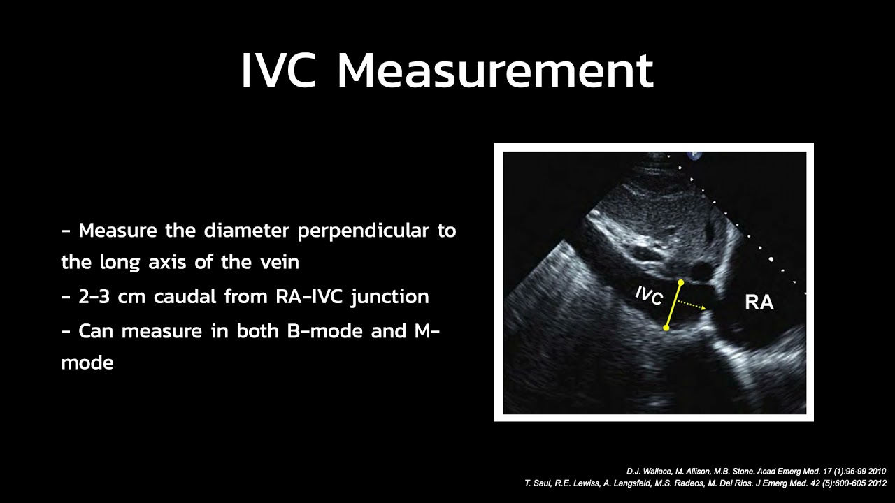 PoCUS: IVC evaluation