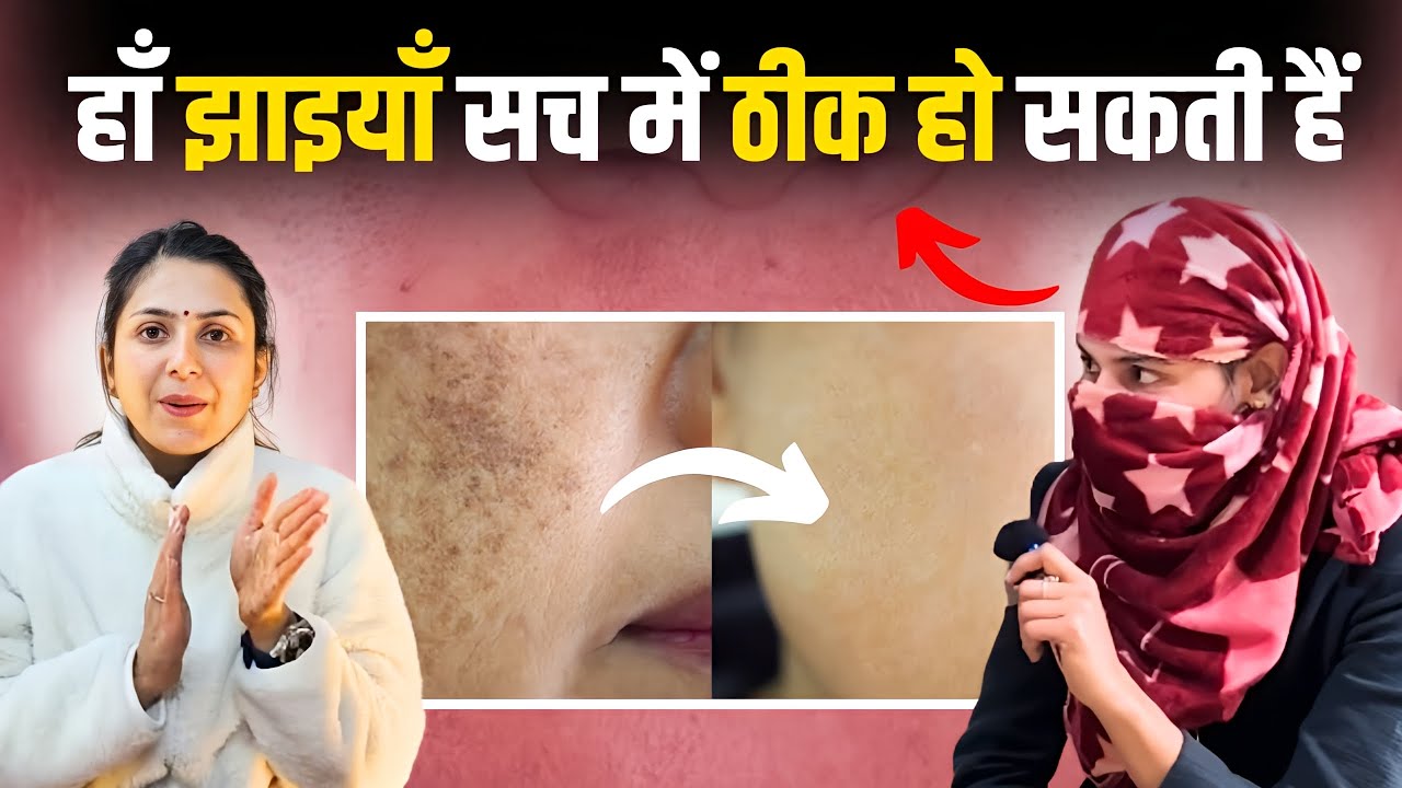 हाँ झाइयाँ हमेशा के लिये ठीक हो सकती हैं | Pigmentation Treatment Patient Review | Dr. Upasana Vohra