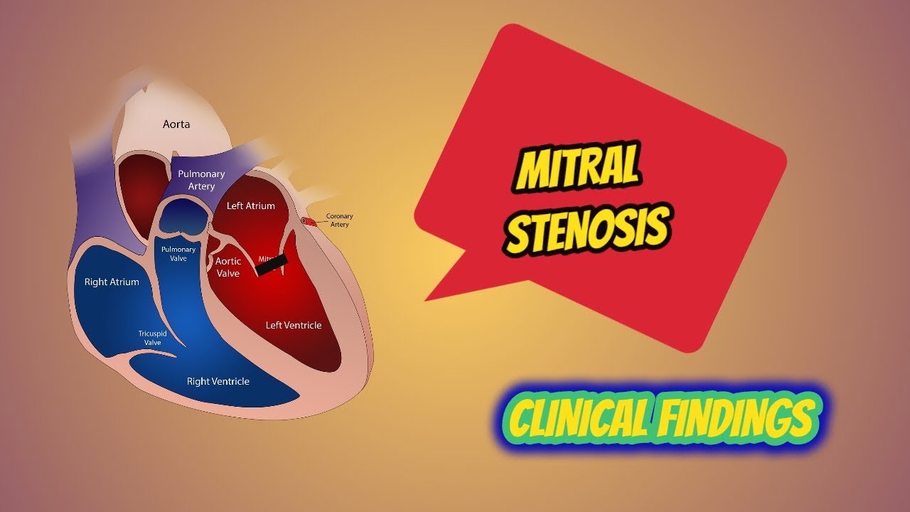 MITRAL STENOSIS