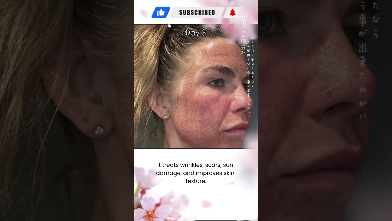 HELIX CO2 Laser: Advanced Skin Resurfacing with Faster Healing & Stunning Results