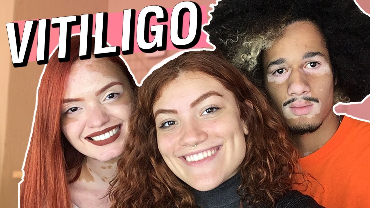 VITILIGO: É DOENÇA? FAZ MAL? COMO FUNCIONA?