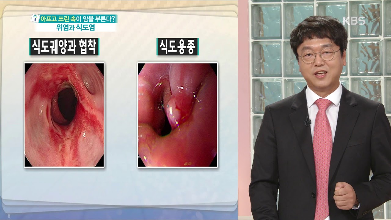 식도궤양과 협착 그리고 식도용종 [무엇이든 물어보세요] 20190806