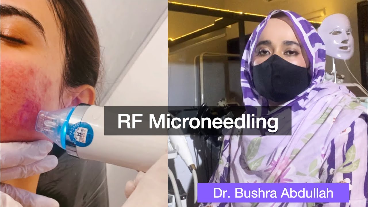 All you need to know about Radio Frequency MICRONEEDLING