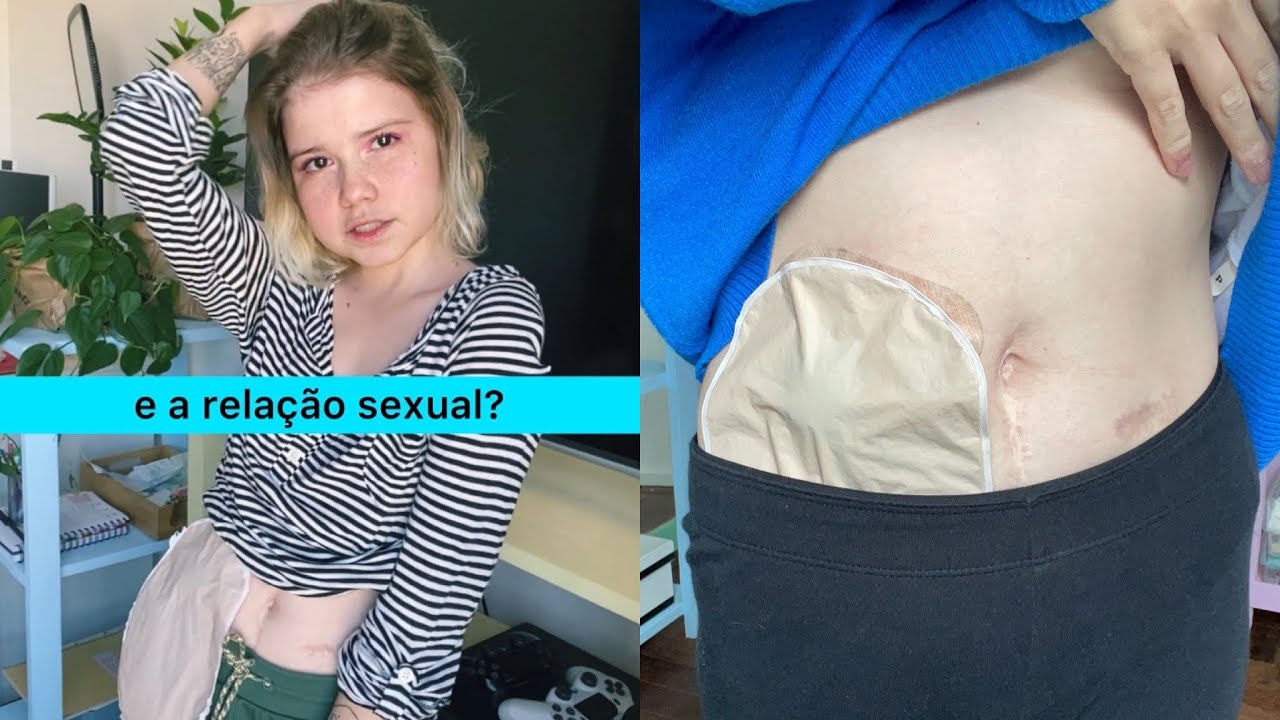 RELAÇÃO S3XU4L com a BOLSINHA DE COLOSTOMIA - ostomizados podem?