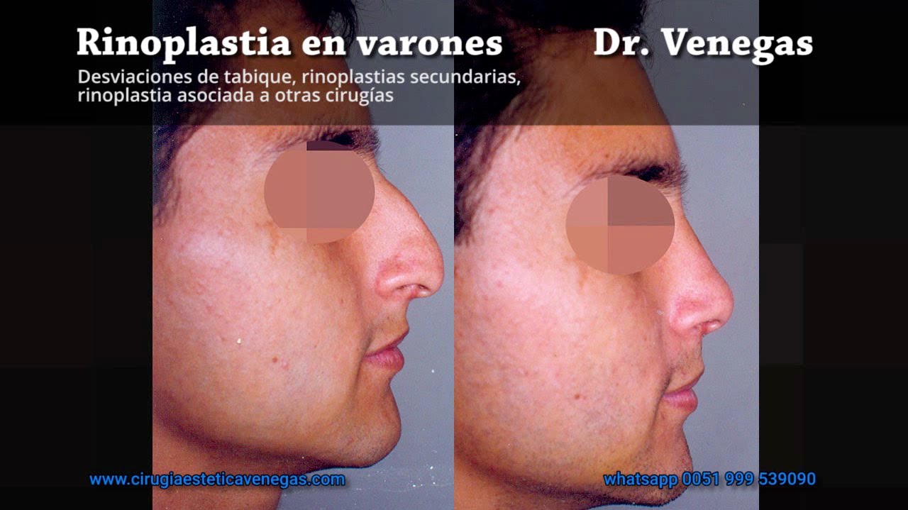 Rinoplastia | Tabique | Cirugía de nariz en varones | Cirujano Plástico | Lima - Peru