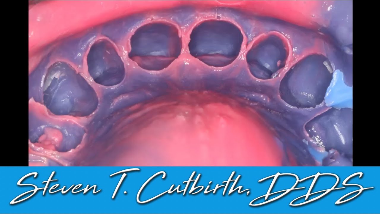 Best Impression Method for Veneers & Crowns - Dental Minute with Steven T. Cutbirth, DDS