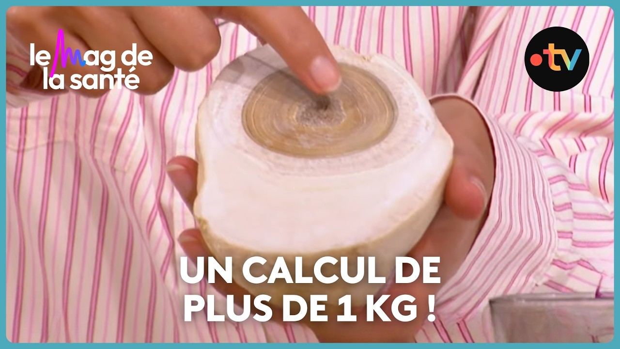 Comment prévenir les calculs rénaux ?