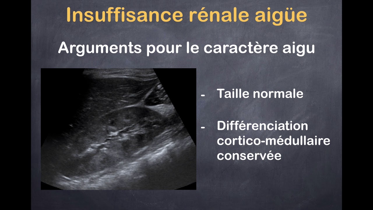 Insuffisance rénale aiguë