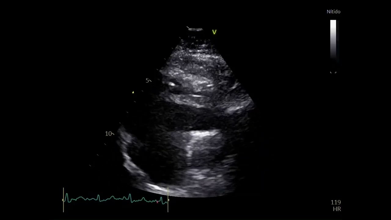 Pulmonary Embolism with an in-transit thrombus