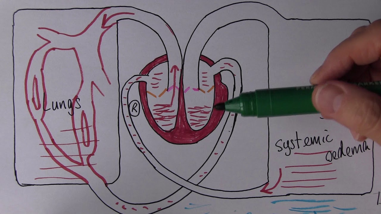 Heart Failure 4, Causes of right ventricular failure