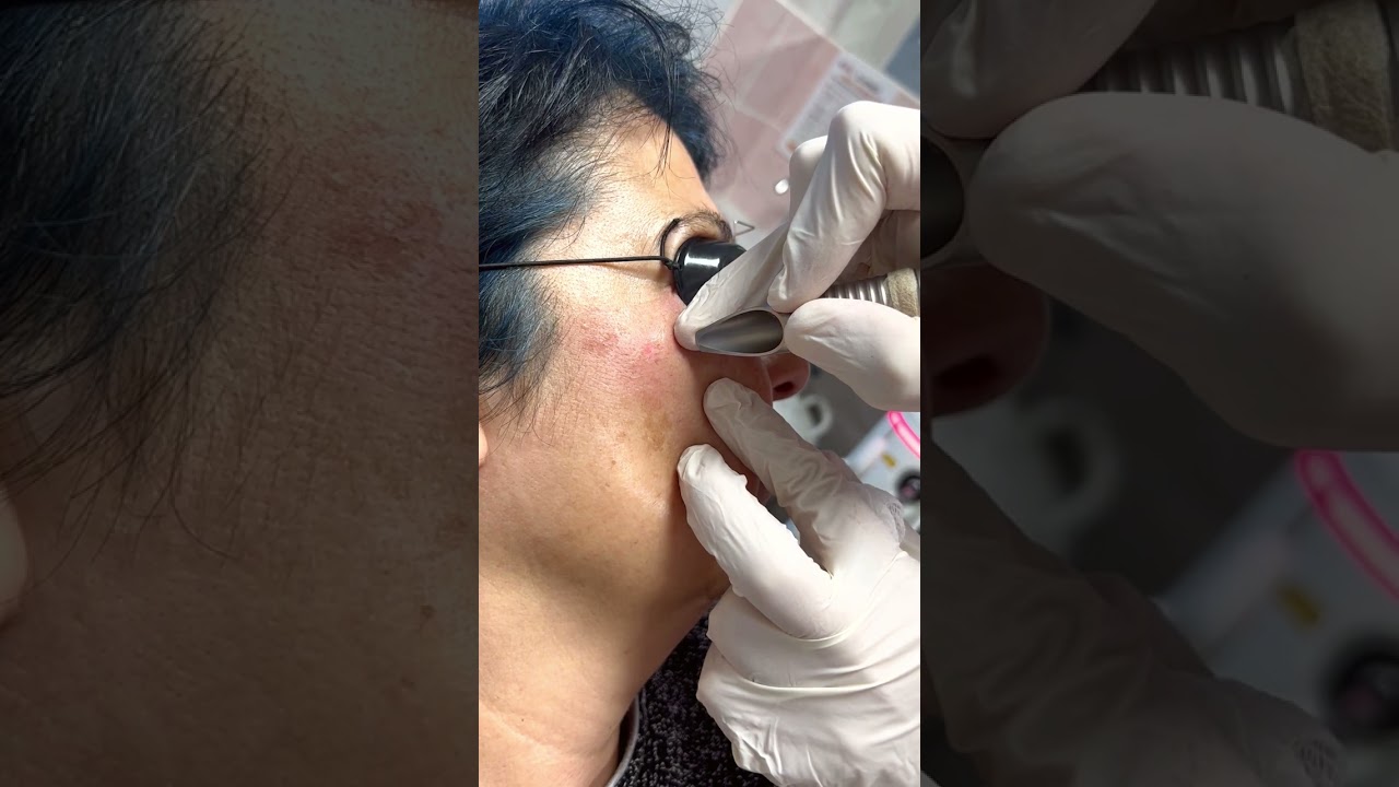 Tek Seansta Leke Tedavisi | Dermatoloji Uzmanı Dr. Onur ER