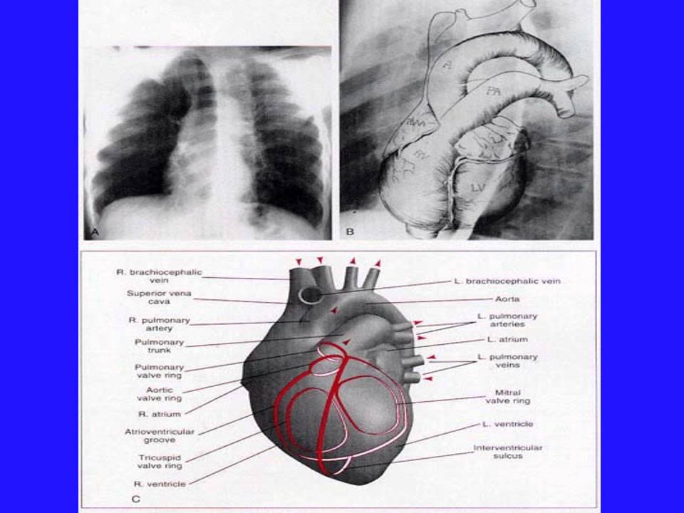 CARDIOLOGIE Radiographie du thorax en cardiologie 2014