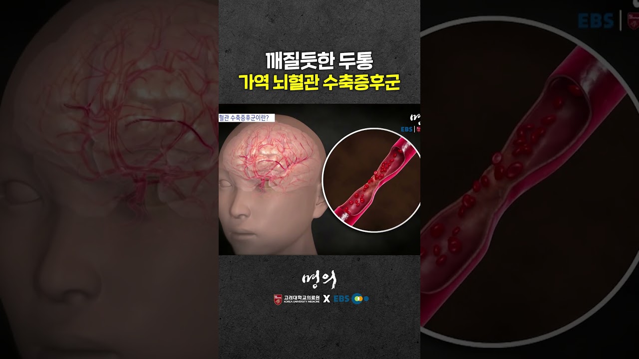 벼락치듯 찾아온 두통 원인은?