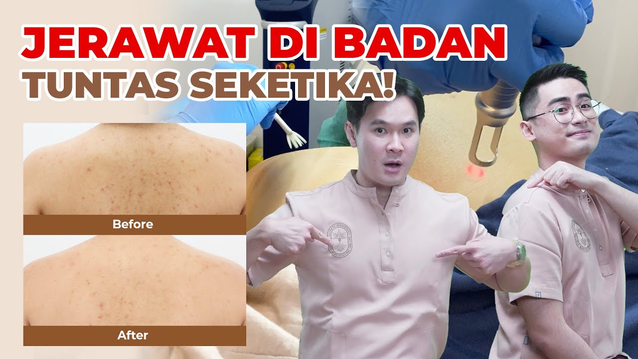 JERAWAT DI BADAN TUNTAS SEKETIKA!
