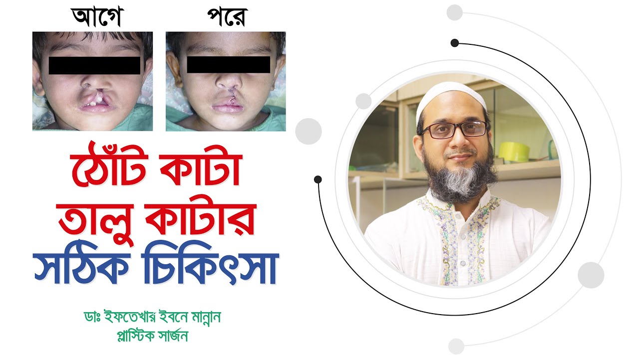 ঠোঁট কাটা ও তালু কাটা শিশুর চিকিৎসা | কখন অপারেশন করবেন?