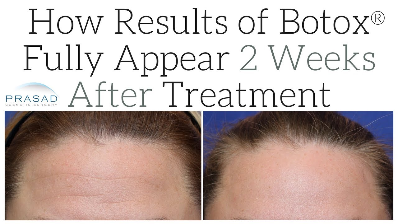 How Full Results of Botox® can Take 2 Weeks After Treatment to Appear