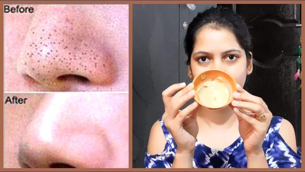 Get Rid of BLACKHEADS AND WHITEHEADS with multani mitti face pack scrub ||TipsToTop By Shalini