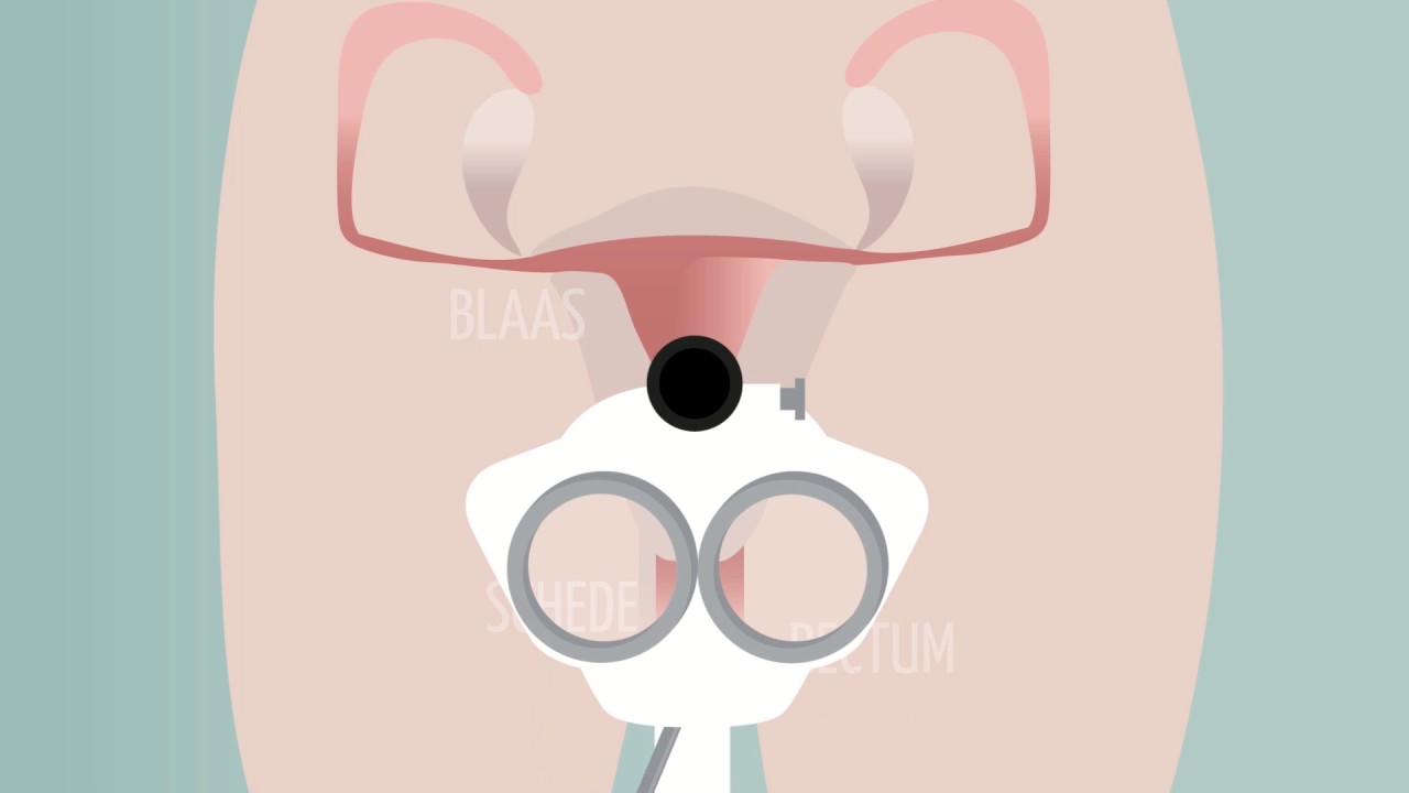 Voorlichtingsvideo Colposcopie / Catharina Ziekenhuis