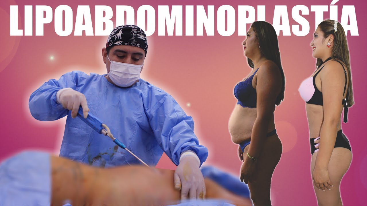 LIPOABDOMINOPLASTÍA 👙 Una TRANSFORMACIÓN extraordinaria 😍 Dr FREDDY CASTILLO 👙 Newlife Perú