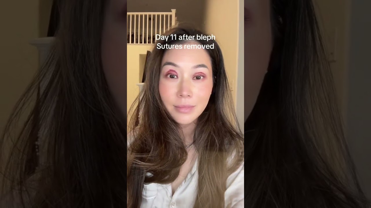Watch me recover from 👀 eyelid surgery. #bleph #upperbleph #eyelidsurgery #eyesurgery #dentist