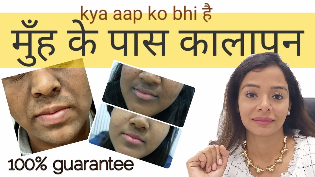 Seborrheic Dermatitis Scalp & Face l रूसी का बेहतरीन उपाय